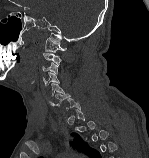 Cervical spine trauma with tear drop fracture and perched facet joint (Radiopaedia 53989-60127 Sagittal bone window 130).jpg