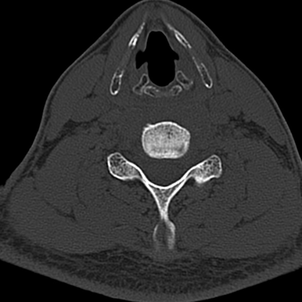 Cervical spondylodiscitis (Radiopaedia 28057-29489 Axial bone window 50).jpg