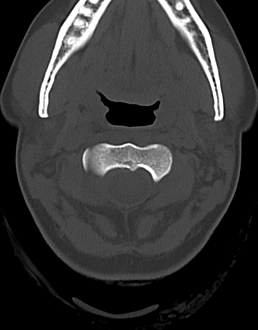 Cervical tuberculous spondylitis (Radiopaedia 39149-41365 Axial bone window 15).png