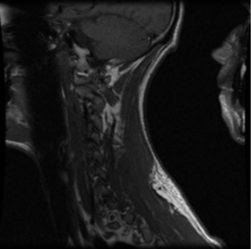 File:Cervical vertebrae metastasis (Radiopaedia 78814-91667 Sagittal T1 2).png