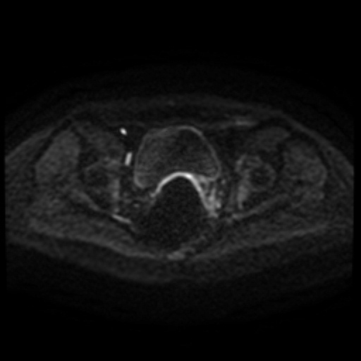 File:Cesarian section scar endometriosis (Radiopaedia 66520-75799 Axial DWI 91).jpg