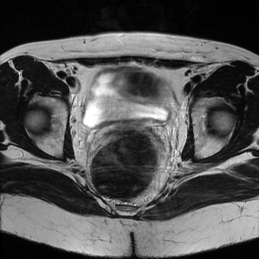 File:Cesarian section scar endometriosis (Radiopaedia 66520-75799 Axial T2 15).jpg