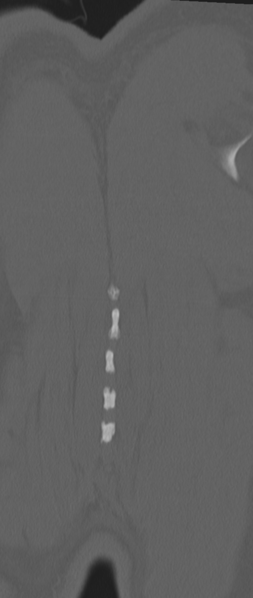 Chance fracture (Radiopaedia 33854-35020 Coronal bone window 86).png