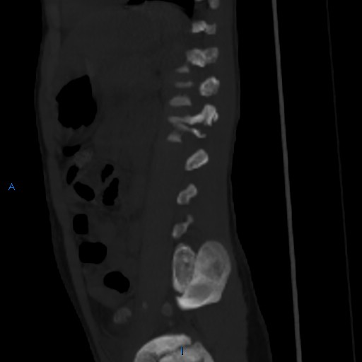 File:Chance fracture with duodenal and pancreatic lacerations (Radiopaedia 43477-50042 Sagittal bone window 2).jpg