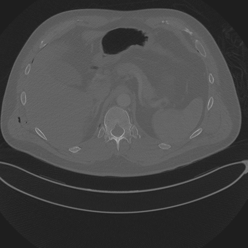 File:Chest multitrauma - aortic injury (Radiopaedia 34708-36147 Axial bone window 292).png