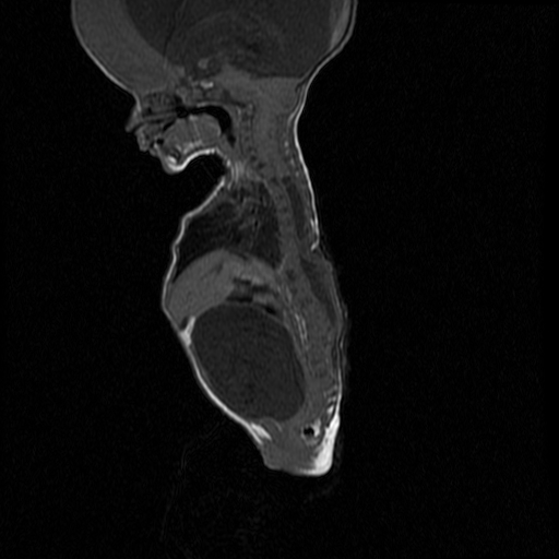 File:Chiari II malformation with spinal meningomyelocele (Radiopaedia 23550-23652 Sagittal T1 6).jpg