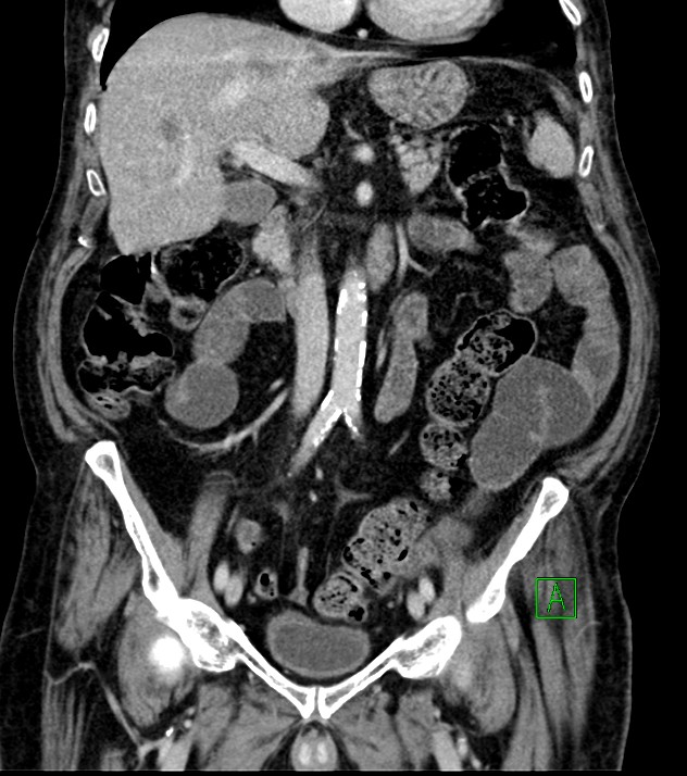 Cholangiocarcinoma with cerebral metastases (Radiopaedia 83519-98629 G 39).jpg