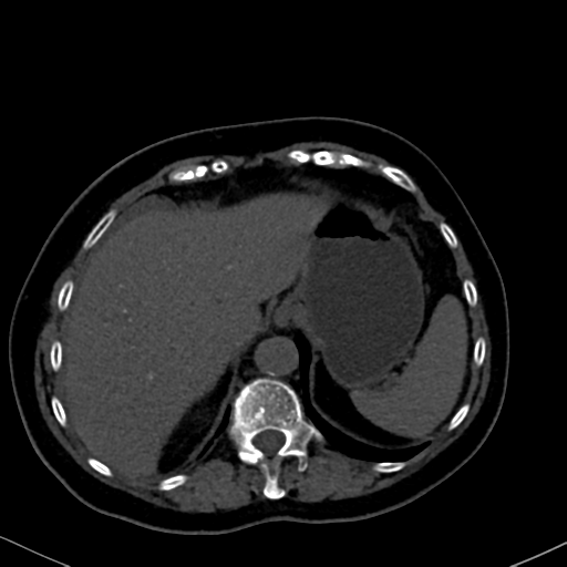 File:Cholecystitis - obstructive choledocholitiasis (CT intravenous cholangiography) (Radiopaedia 43966-47479 Axial 109).png