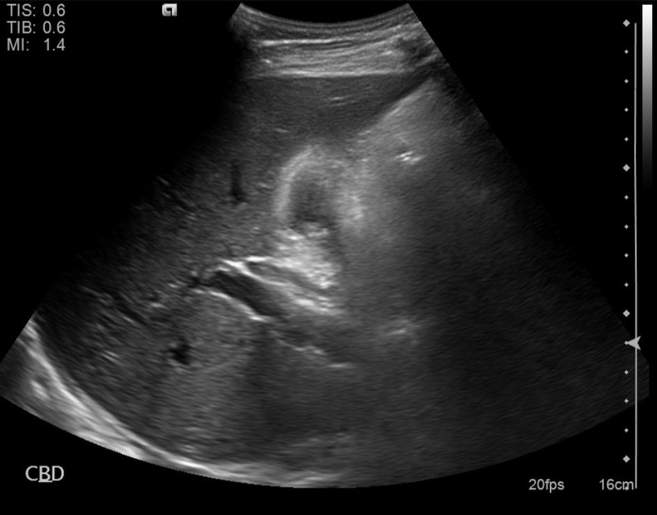 File:Cholecystitis - perforated gallbladder (Radiopaedia 57038-63913 A 6).jpg