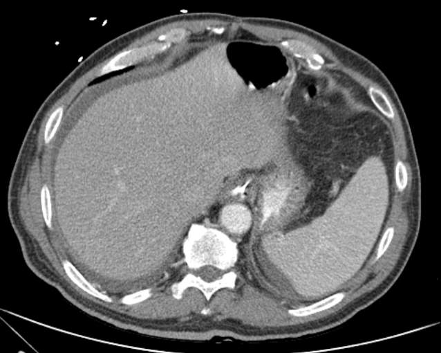 File:Cholecystitis - perforated gallbladder (Radiopaedia 57038-63916 A 16).jpg