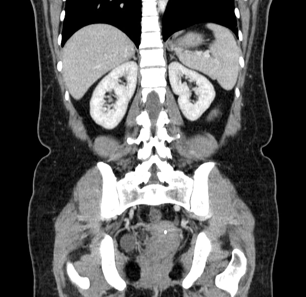 Choledocholithiasis on CT and MRI (Radiopaedia 24825-25087 C 36).jpg