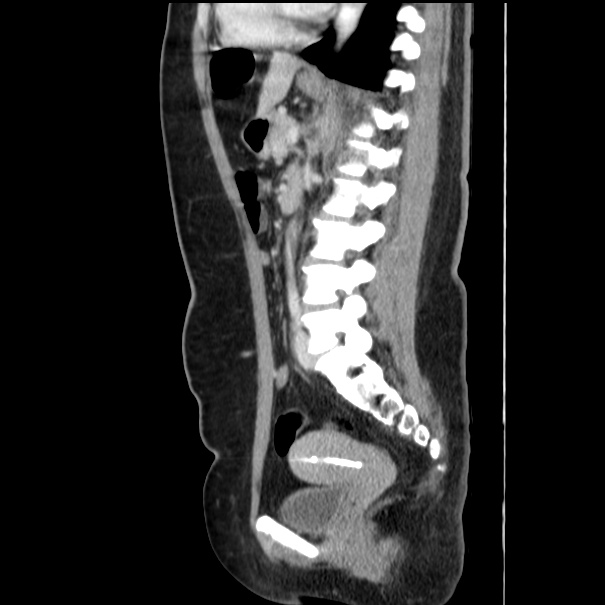 Choledocholithiasis on CT and MRI (Radiopaedia 24825-25087 D 37).jpg
