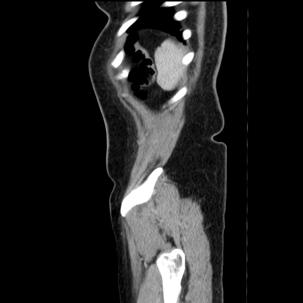 Choledocholithiasis on CT and MRI (Radiopaedia 24825-25087 D 58).jpg