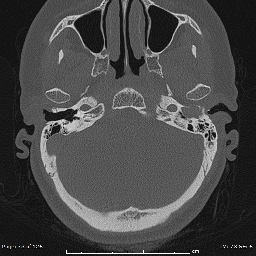 Cholesteatoma - external auditory canal (Radiopaedia 88452-105096 Axial bone window 36).jpg