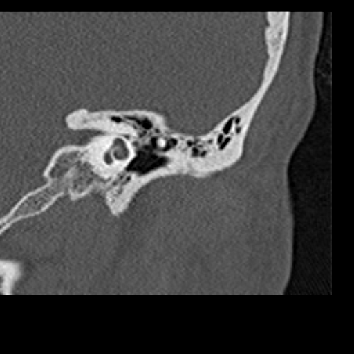 File:Cholesteatoma of the external ear (Radiopaedia 16540-16225 Coronal bone window 8).jpg