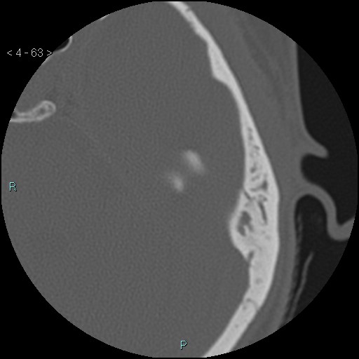 File:Cholesterol granuloma of the petrous apex (Radiopaedia 64358-73141 Axial bone window 31).jpg