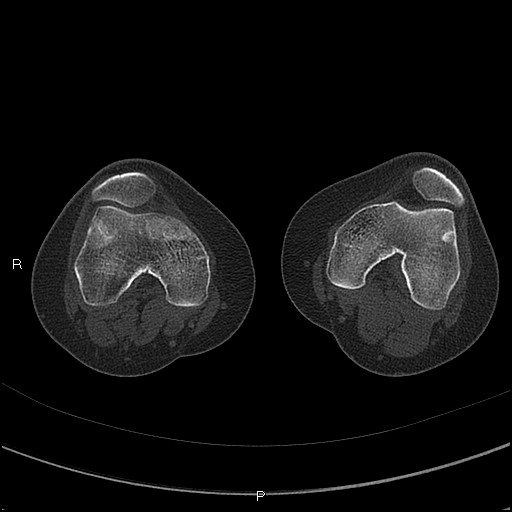 Chondroblastoma (Radiopaedia 62721-71030 Axial bone window 9).jpg