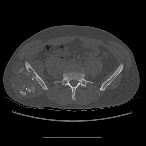 File:Chondrosarcoma of iliac wing (Radiopaedia 63861-72599 Axial bone window 37).jpg