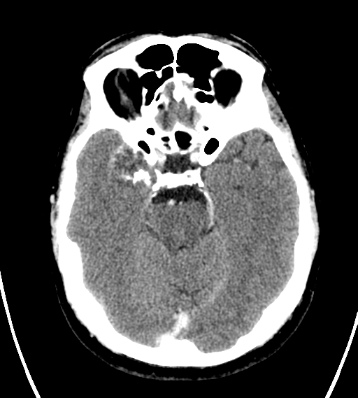 File:Chondrosarcoma of skull base- grade II (Radiopaedia 40948-43653 Axial Contrast 11).png