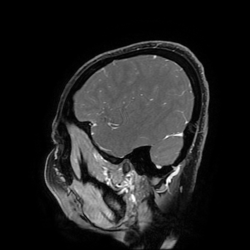 Chordoid glioma of third ventricle (Radiopaedia 91612-109340 F 164).jpg