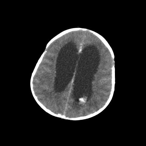 Choroid plexus papilloma (Radiopaedia 63946-72698 Axial with contrast 53).jpg