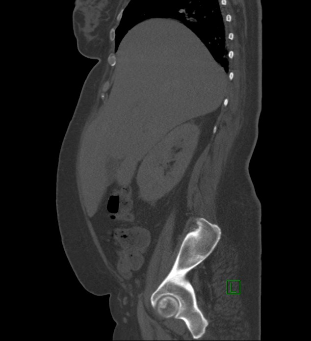 Chromophobe renal cell carcinoma (Radiopaedia 84239-99519 Sagittal bone window 78).jpg