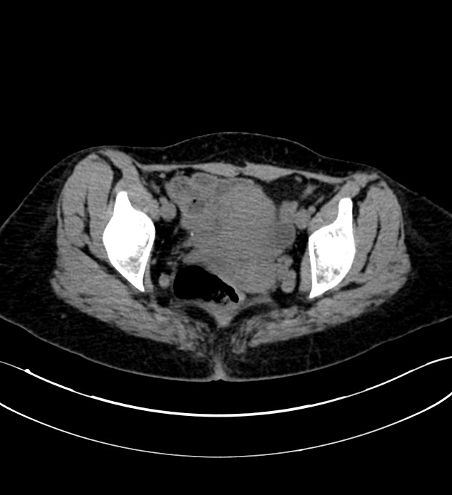 Chromophobe renal cell carcinoma (Radiopaedia 84290-99582 Axial non-contrast 134).jpg