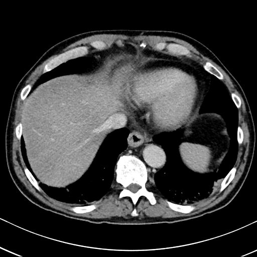 Chronic appendicitis complicated by appendicular abscess, pylephlebitis and liver abscess (Radiopaedia 54483-60700 B 25).jpg