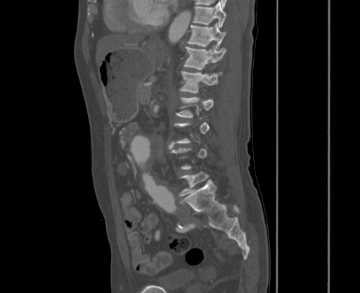 File:Chronic contained rupture of abdominal aortic aneurysm with extensive erosion of the vertebral bodies (Radiopaedia 55450-61901 Sagittal bone window 37).jpg