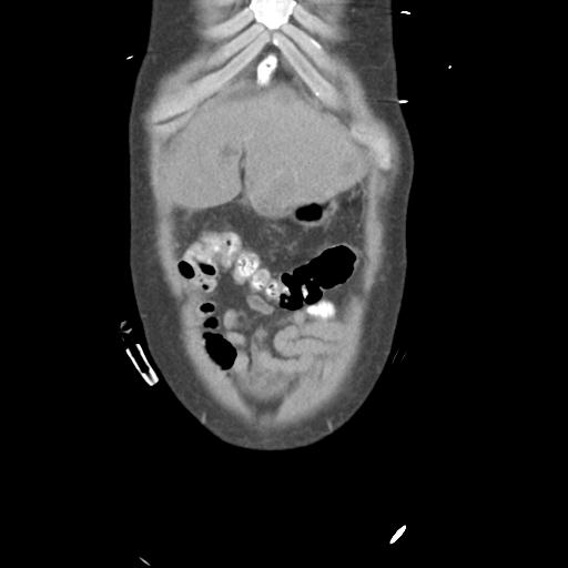 Chronic diverticulitis complicated by hepatic abscess and portal vein thrombosis (Radiopaedia 30301-30938 B 11).jpg