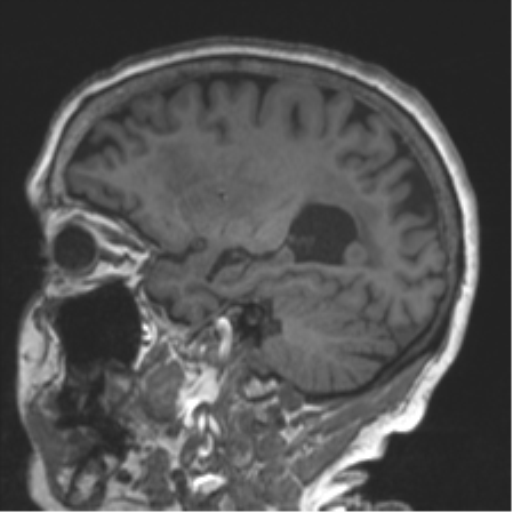 Chronic hypertensive encephalopathy (Radiopaedia 39993-42482 Sagittal T1 34).png