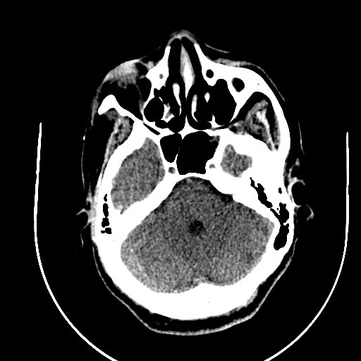Chronic invasive fungal sinusitis (Radiopaedia 91563-109286 Axial non-contrast 23).jpg