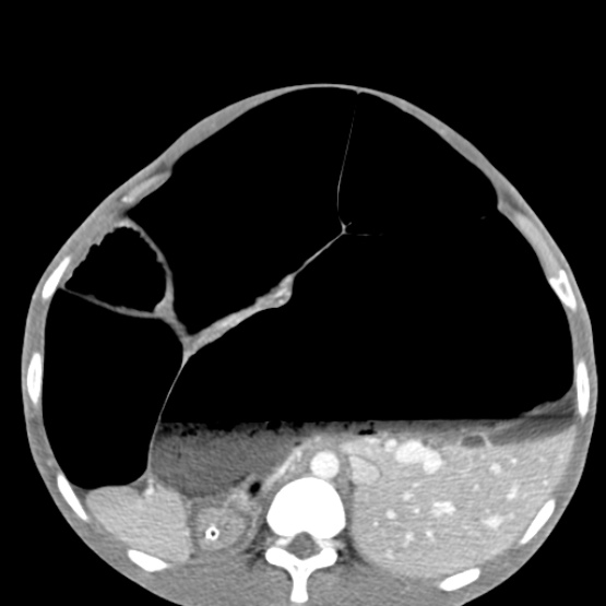 File:Chronic large bowel pseudo-obstruction (Radiopaedia 43181-46492 A 62).jpg