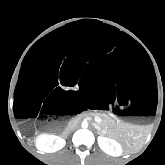 File:Chronic large bowel pseudo-obstruction (Radiopaedia 43181-46492 A 81).jpg
