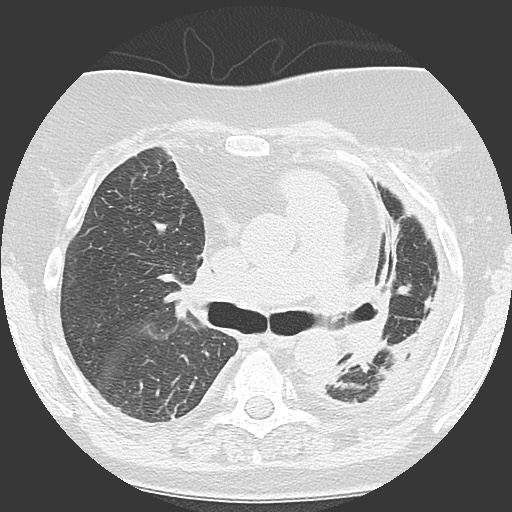 Chronic lung allograft dysfunction - restrictive form (Radiopaedia 60595-68316 Axial lung window 29).jpg