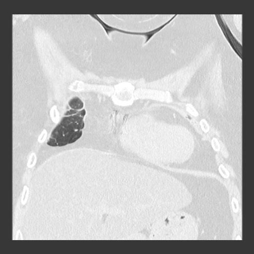 Chronic lung allograft dysfunction - restrictive form (Radiopaedia 60595-68316 Coronal lung window 30).jpg