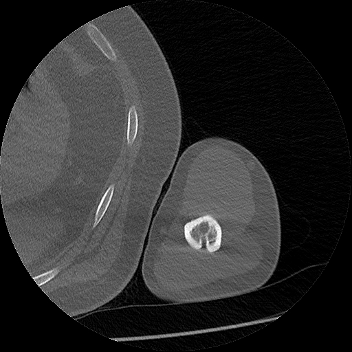 Chronic osteomyelitis (Radiopaedia 67597-76998 Axial bone window 41).jpg