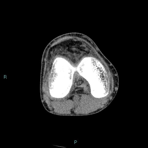 Chronic osteomyelitis (with Brodie abscess) (Radiopaedia 76405-88111 A 119).jpg