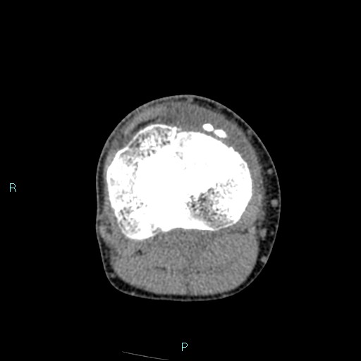 Chronic osteomyelitis (with Brodie abscess) (Radiopaedia 76405-88111 A 95).jpg