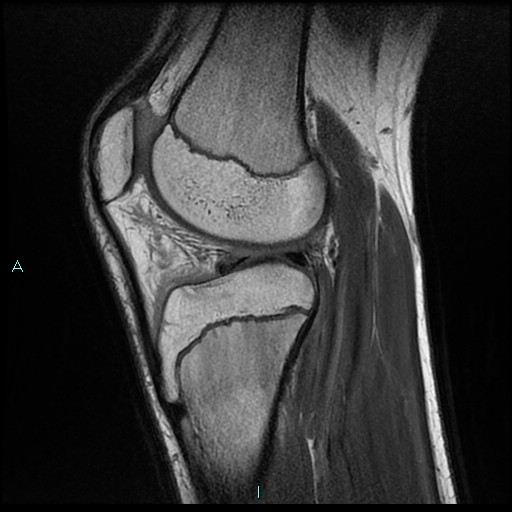 File:Chronic osteomyelitis (with Brodie abscess) (Radiopaedia 76405-88112 Sagittal PD 17).jpg