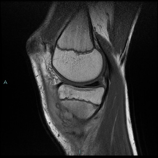 File:Chronic osteomyelitis (with Brodie abscess) (Radiopaedia 76405-88112 Sagittal PD 8).jpg