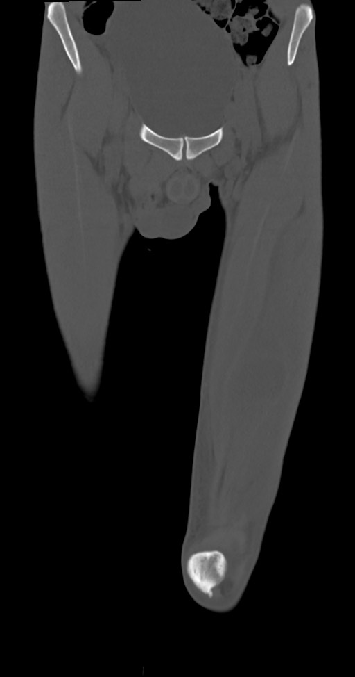 Chronic osteomyelitis (with sequestrum) (Radiopaedia 74813-85822 Coronal non-contrast 11).jpg