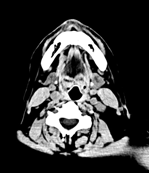 File:Chronic osteomyelitis - calvarial (severe) (Radiopaedia 69668-79616 Axial non-contrast 2).jpg