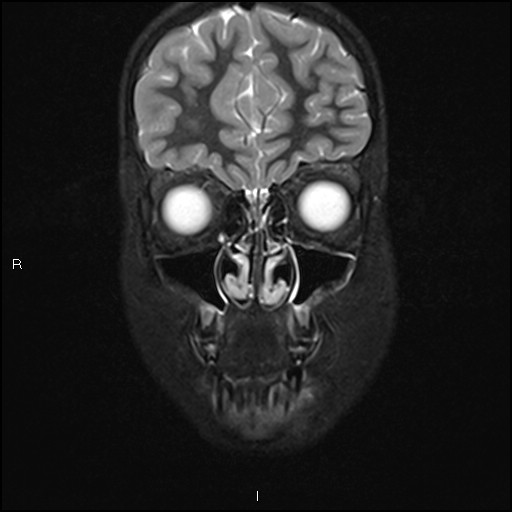 File:Chronic reactive multifocal osteomyelitis (CRMO) - mandible (Radiopaedia 56405-63069 Coronal STIR 9).jpg