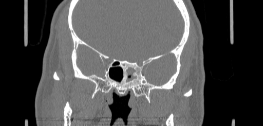 Chronic sphenoidal sinusitis (Radiopaedia 62030-70122 Coronal bone window 111).jpg