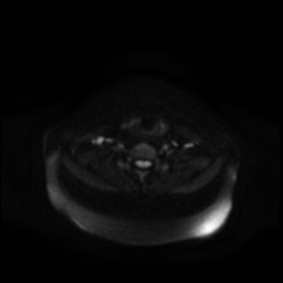 Chronic submandibular sialadenitis (Radiopaedia 61852-69885 Axial DWI 21).jpg