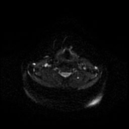 Chronic submandibular sialadenitis (Radiopaedia 61852-69885 Axial DWI 50).jpg