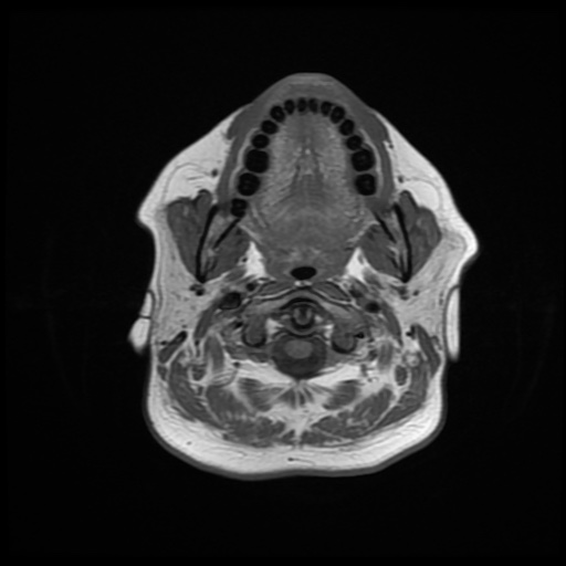 File:Chronic submandibular sialadenitis (Radiopaedia 61852-69885 Axial T1 9).jpg