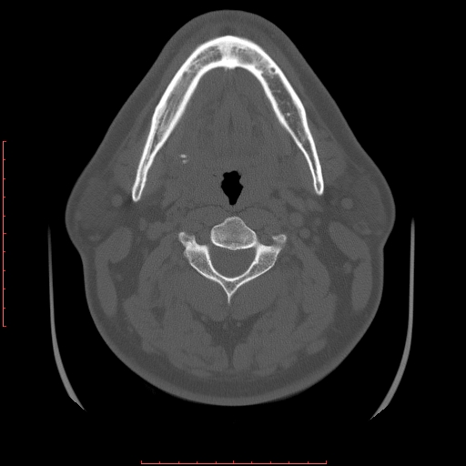 Chronic submandibular sialolithiasis (Radiopaedia 69817-79814 Axial bone window 66).jpg