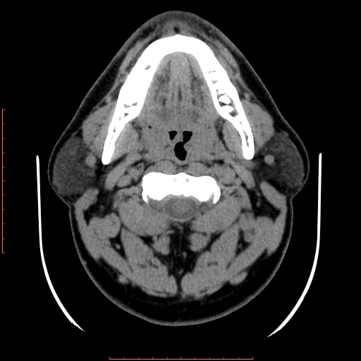 Chronic submandibular sialolithiasis (Radiopaedia 69817-79814 Axial non-contrast 82).jpg